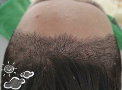 -大麦微针植发丨全国连锁