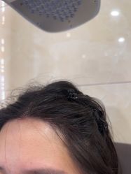 -碧莲盛·不剃发植发