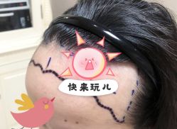 -大麦微针植发全国连锁