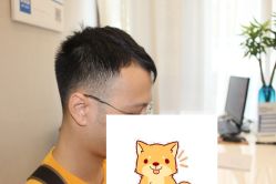 -大麦微针植发丨全国连锁