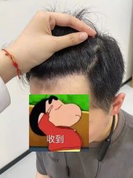 体验后-大麦微针植发全国连锁