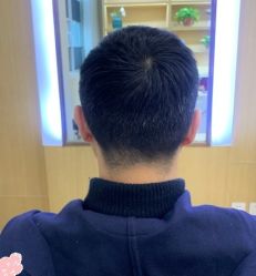 -大麦微针植发丨全国连锁