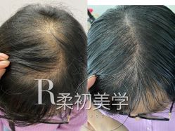 -RC半永久纹眉纹发际线