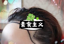 -大麦微针植发全国连锁