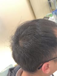 -碧莲盛·不剃发植发