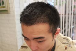 点击看大图 -大麦微针植发丨全国连锁