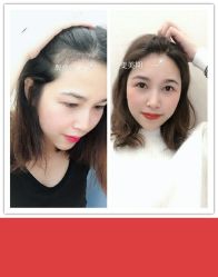 -大麦微针植发全国连锁