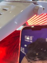 -碧莲盛·不剃发植发