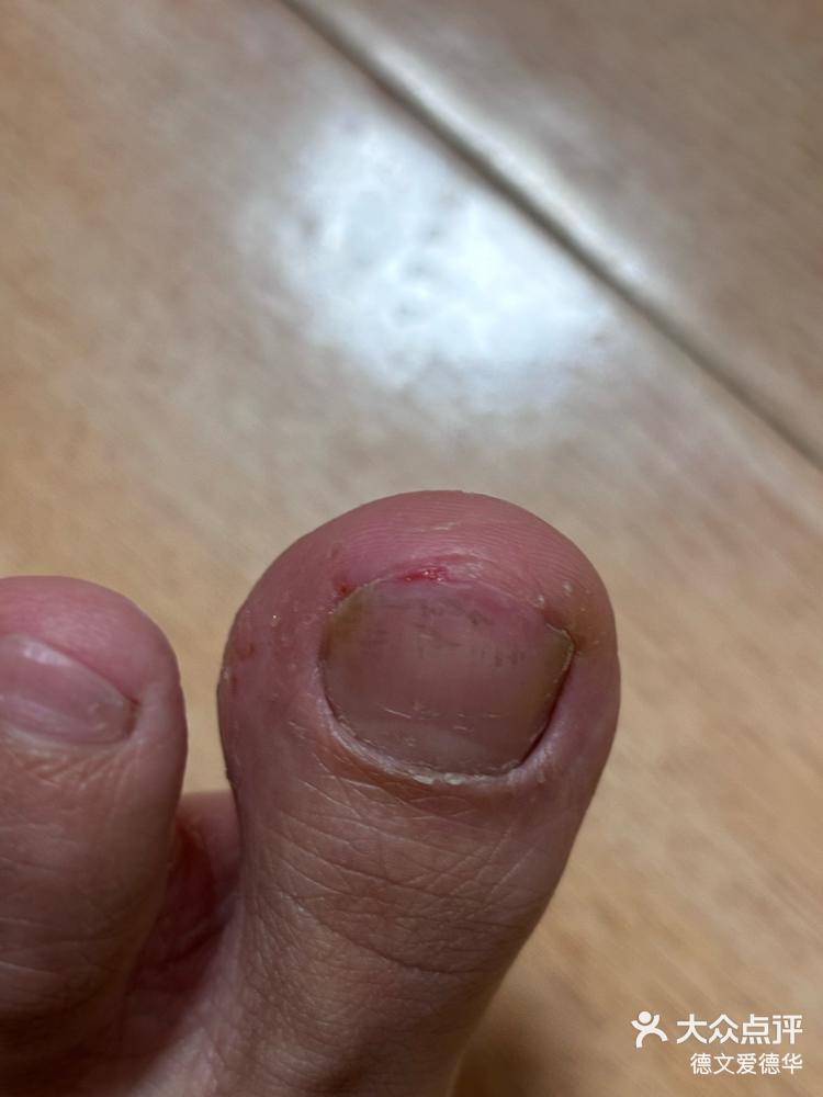 修脚被修出血如何处理