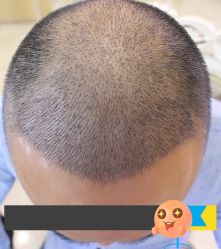 -大麦微针植发丨全国连锁