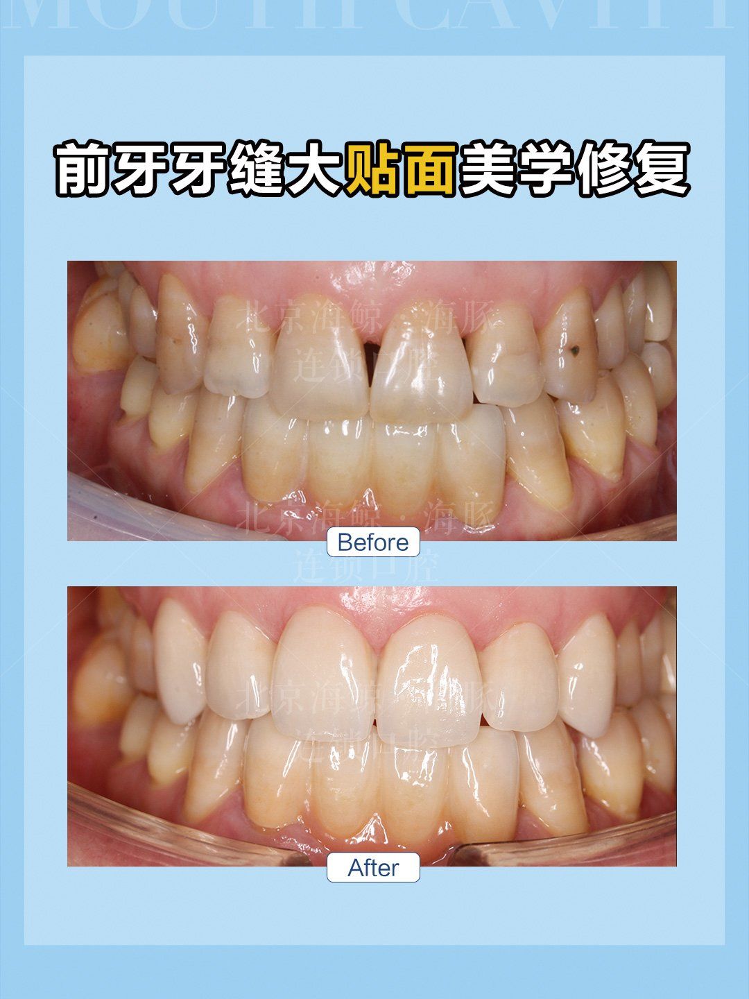 前牙牙缝大贴面美学修复
