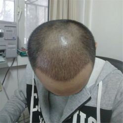 -碧莲盛·不剃发植发