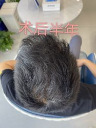 点击看大图 -大麦微针植发全国连锁