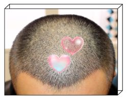 -大麦微针植发全国连锁