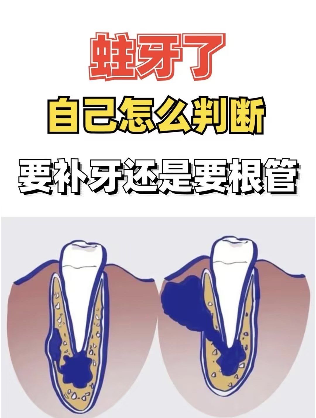 蛀牙了,怎么判断要补牙还是根管治疗呢?