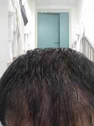 点击看大图 -大麦微针植发丨全国连锁