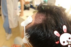 点击看大图 -大麦微针植发丨全国连锁