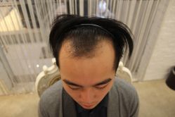 -大麦微针植发丨全国连锁