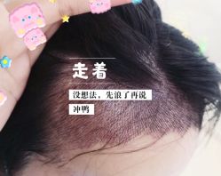 -大麦微针植发全国连锁