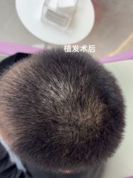 -北京雍禾植发医院