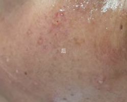 -美丽人生祛斑扁平疣汗管瘤中心