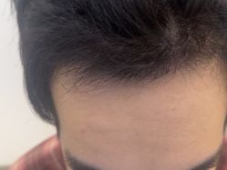 -大麦微针植发丨全国连锁