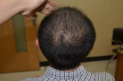 -大麦微针植发丨全国连锁