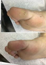 -德哥灰指甲脚气甲沟炎跖疣护理
