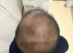 -大麦微针植发丨全国连锁