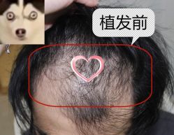 -大麦微针植发丨全国连锁