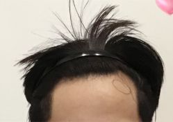 -大麦微针植发全国连锁