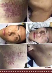 祛痘效果-苗方清颜专业祛痘