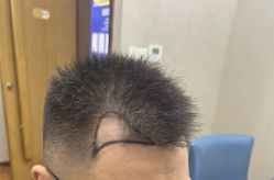 -大麦微针植发全国连锁