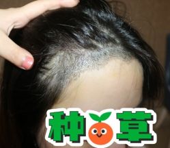 -大麦微针植发丨全国连锁