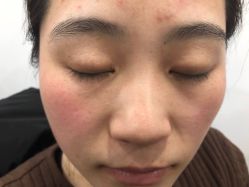 -美丽人生祛斑扁平疣汗管瘤中心