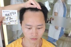 点击看大图 -大麦微针植发丨全国连锁