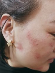体验前-北京美痣堂古方祛痣斑疣瘊