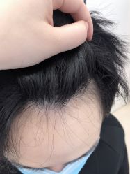 点击看大图 -大麦微针植发丨全国连锁