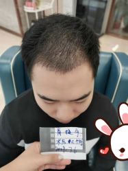 -大麦微针植发丨全国连锁