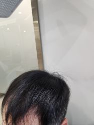 点击看大图 -碧莲盛·不剃发植发