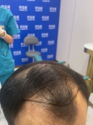 -碧莲盛不剃发植发