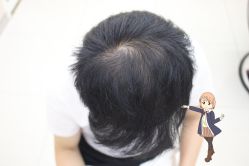 -大麦微针植发丨全国连锁