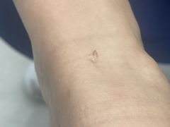 -Andrew指甲专科灰指甲·甲沟炎矫正·3D步态矫形鞋垫定制(浦三路店)