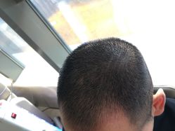 -碧莲盛·不剃发植发