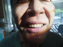 -上海仁爱医院口腔科 · 种植