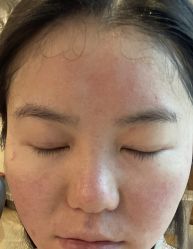 体验后-四川娇点医学美容医院