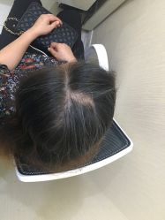 -碧莲盛·不剃发植发