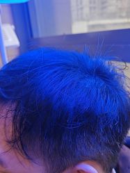 -碧莲盛·不剃发植发