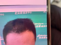 -雍禾植发
