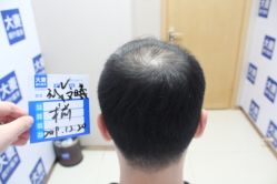 -大麦微针植发丨全国连锁